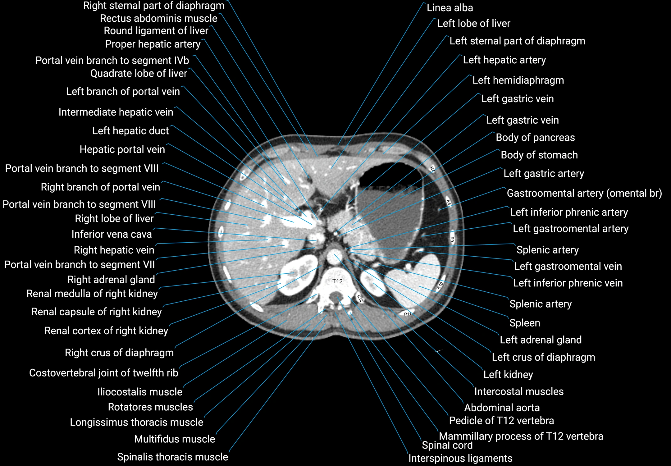 CT male pelvis axial cross sectional anatomy labelled radiology image -00039.webp